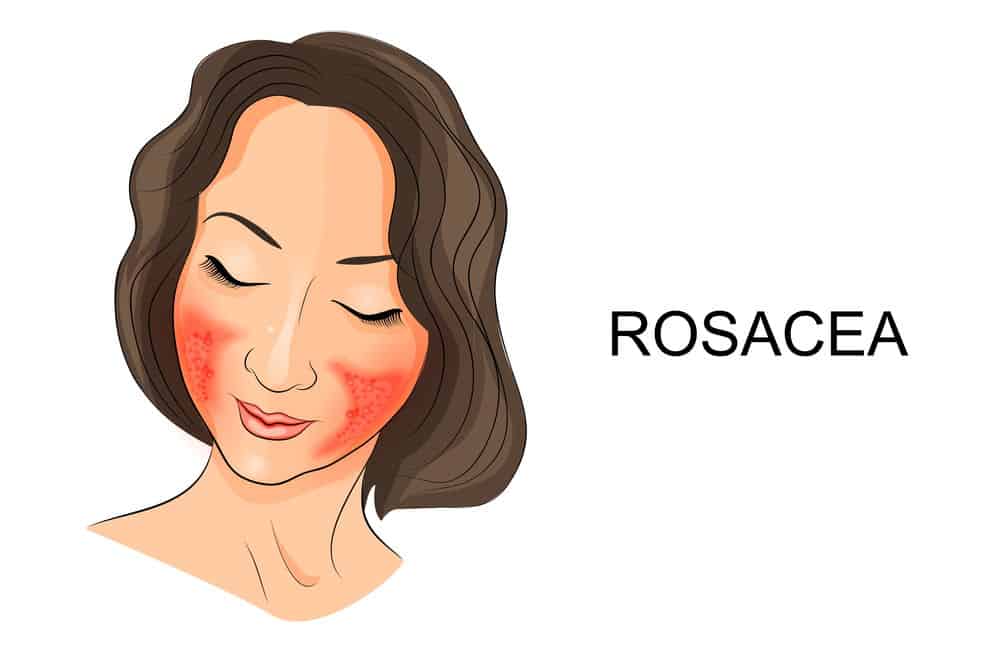 how to get rid of rosacea