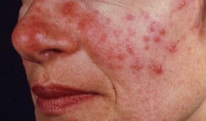 Papulopustular Rosacea