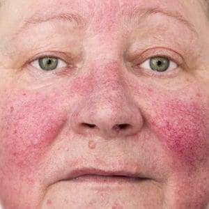 rosacea