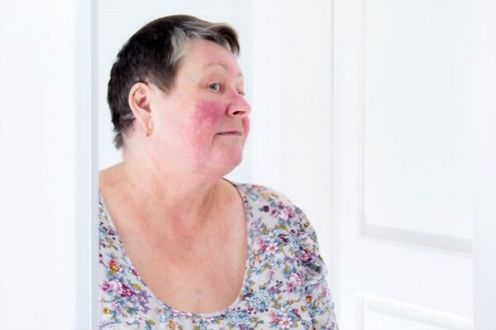 rosacea on one side of face rosacea on one side of face