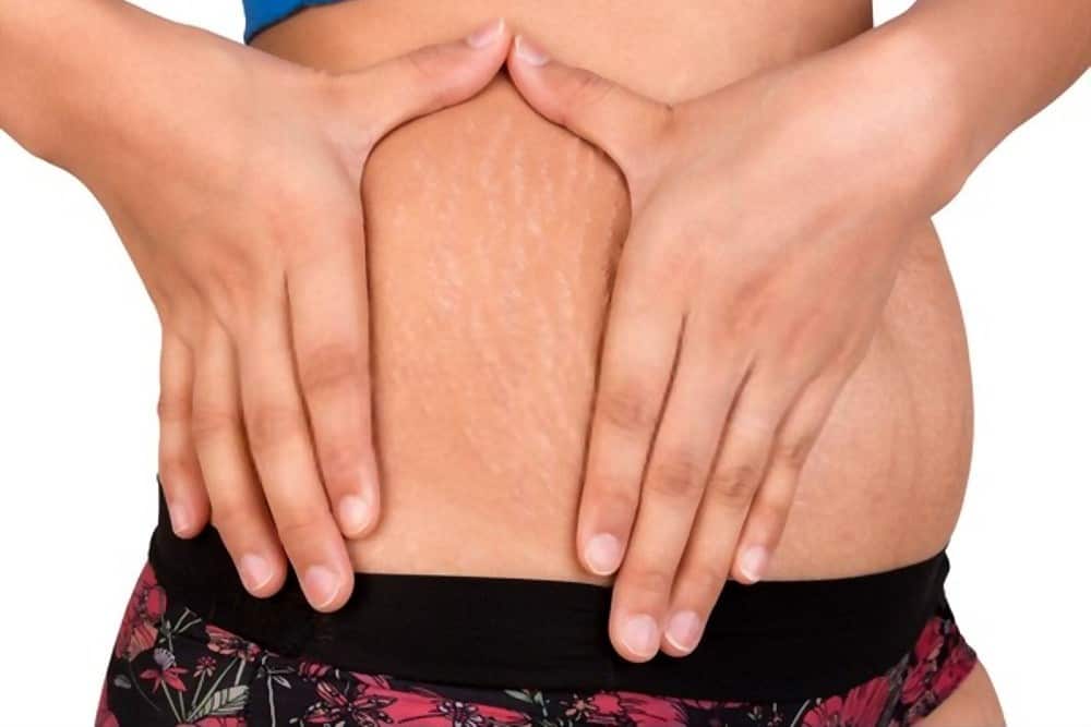 Does Stretch Marks Go Away After Weight Loss