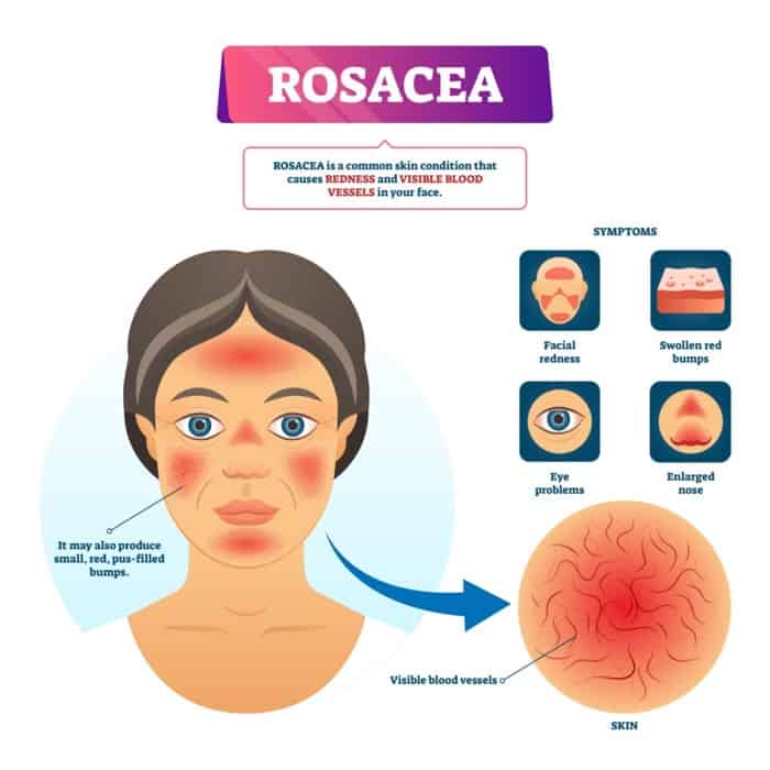 Rosacea vector illustration