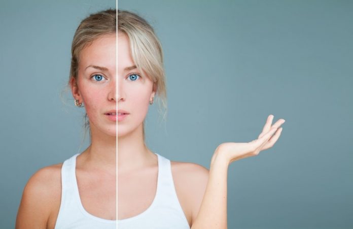 home remedies for rosacea bumps home remedies for rosacea bumps