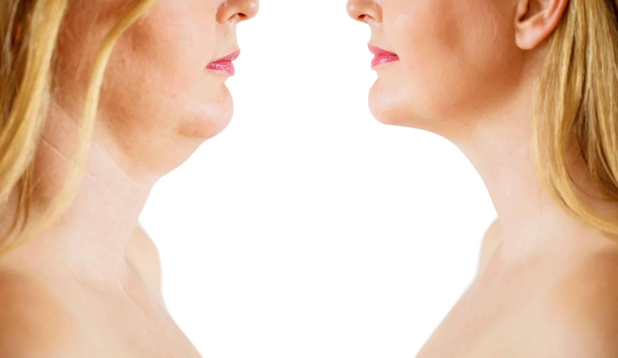 how-to-get-rid-of-loose-skin-under-chin-naturally