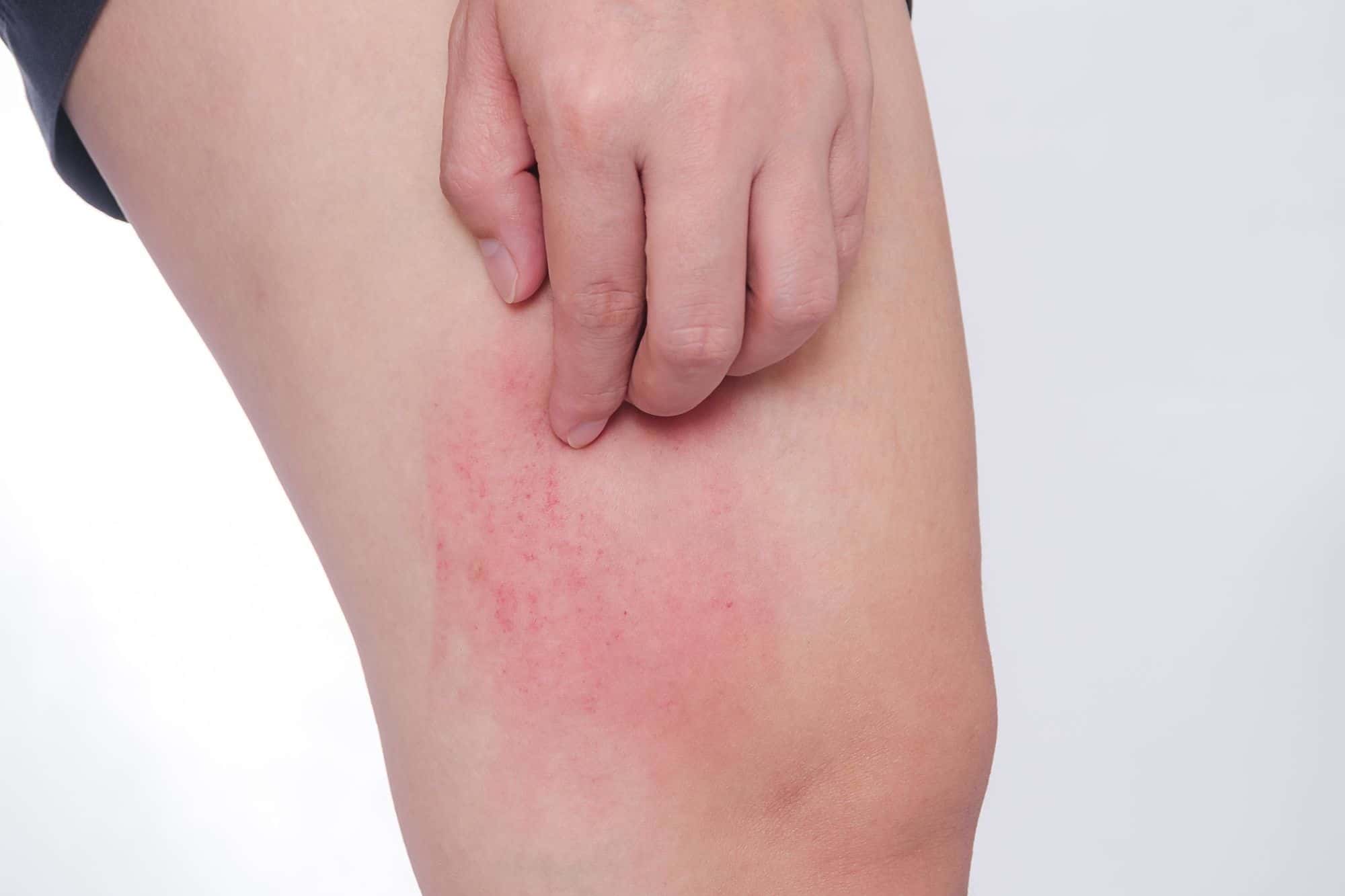 What Cause Pimples Between Thighs