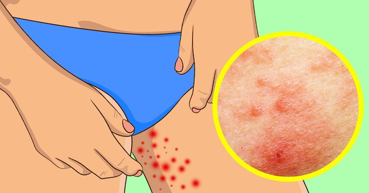 Why Do I Get Pimples on My Inner Thighs?