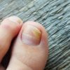 How To Avoid Toenail Fungus In The Summer featured image