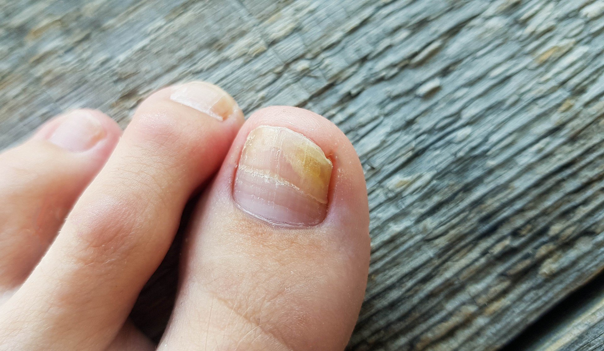 How To Avoid Toenail Fungus In The Summer featured image