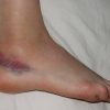 Should I go to the ER for a Sprained Ankle