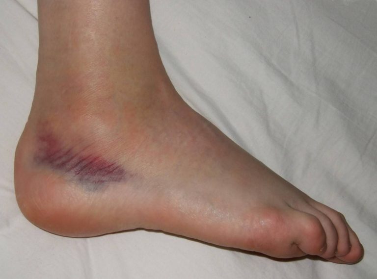 Should I go to the ER for a Sprained Ankle?