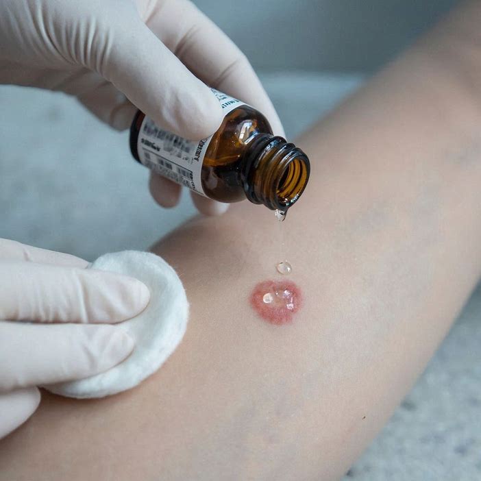 Does Isopropyl Alcohol Kill Ringworm