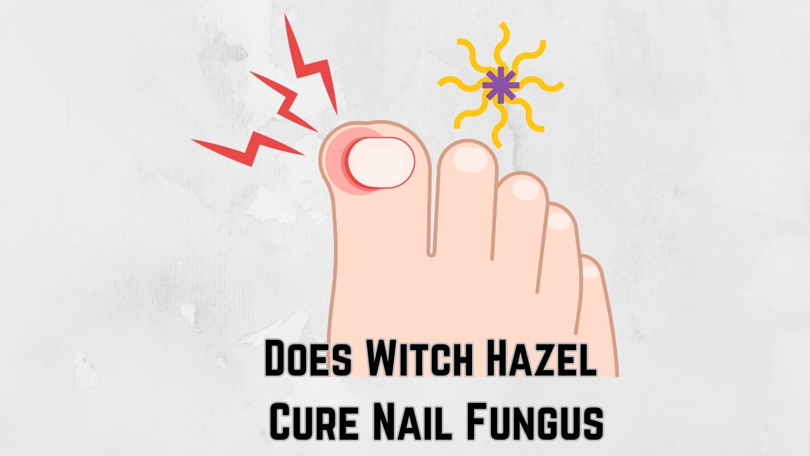 Does Witch Hazel Cure Nail Fungus