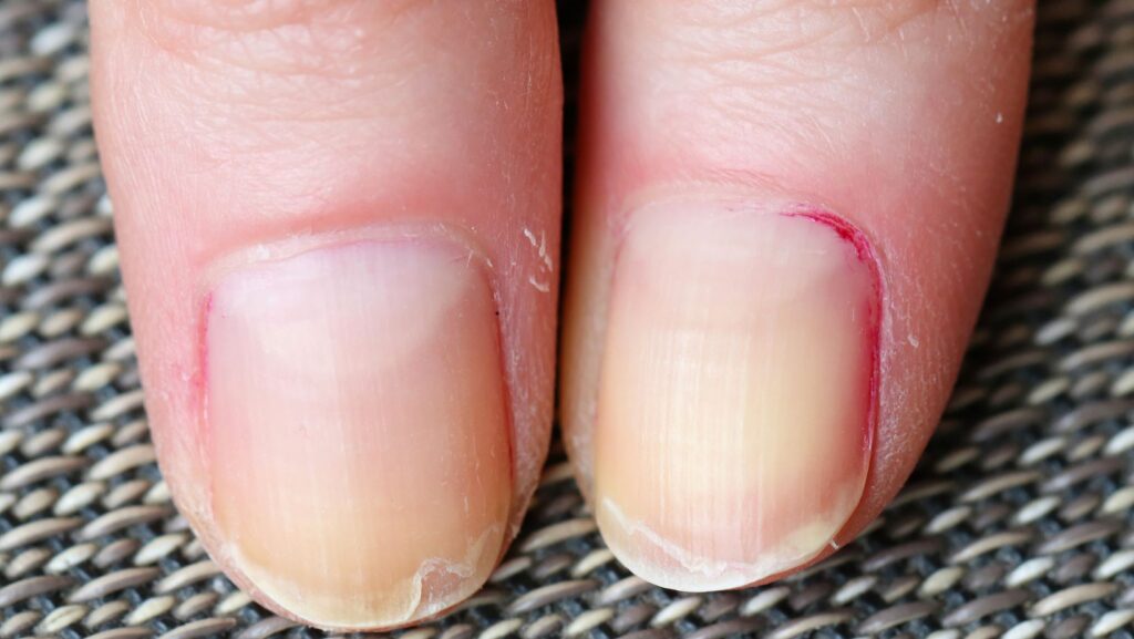 Fingernails Brittle